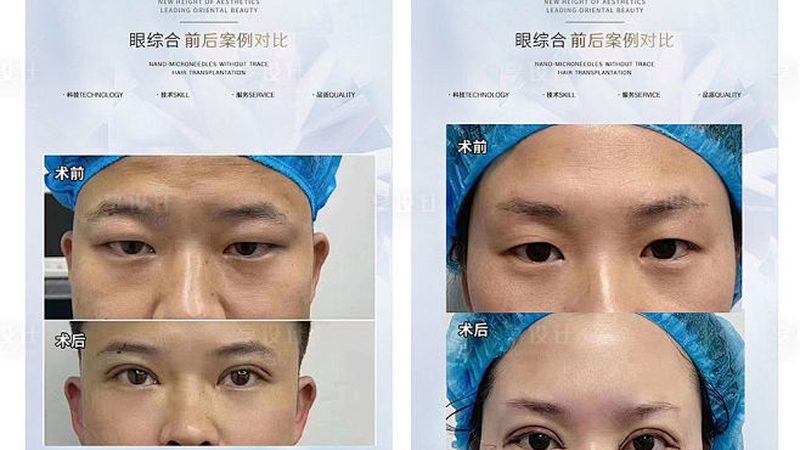 注射美容：揭秘禁忌症与适应症**