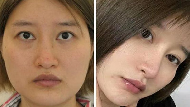 注射美容，这些禁忌症你了解吗？**