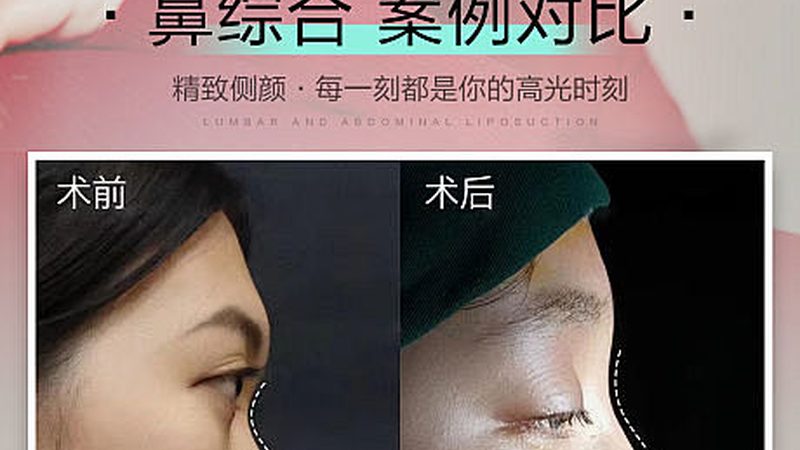 激光祛斑与光子嫩肤：副作用小之选，揭秘两者的差异