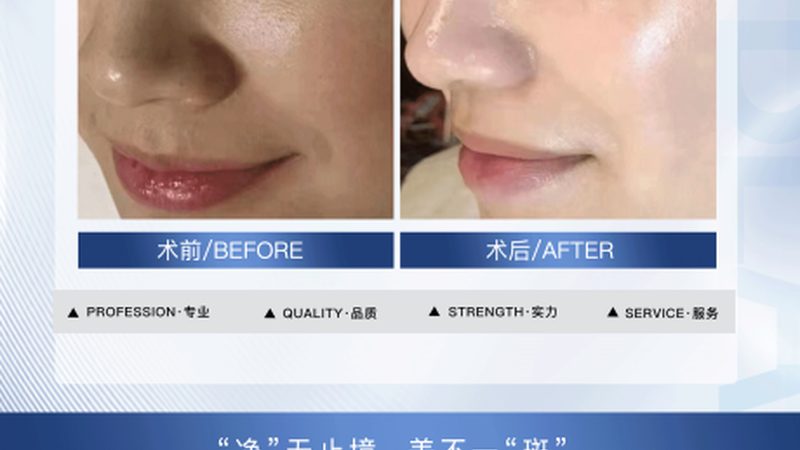 光子嫩肤家用版：揭秘价格背后的技术秘密