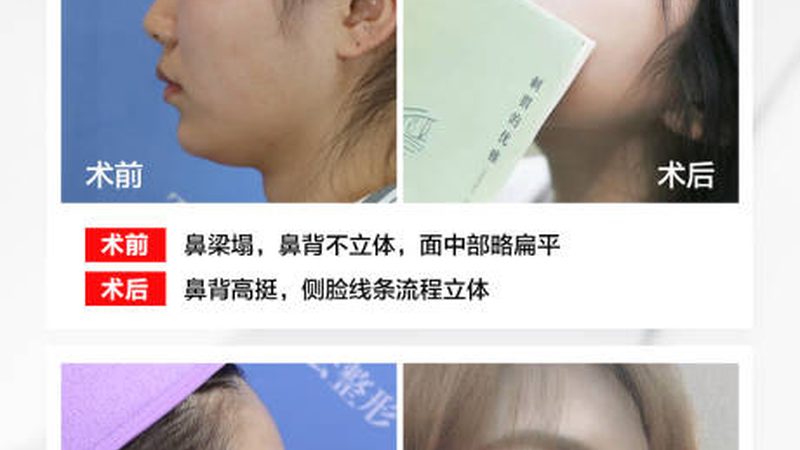 在进行激光脱毛前，应注意以下几点：