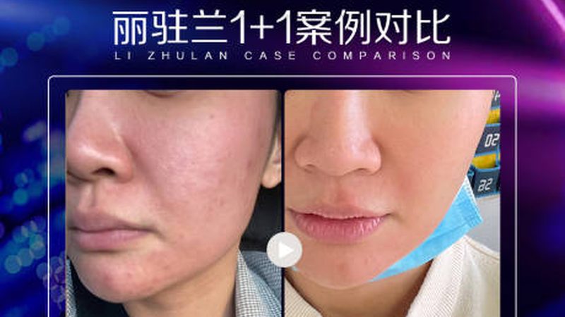 激光祛斑仪器操作方法：安全与细节并重