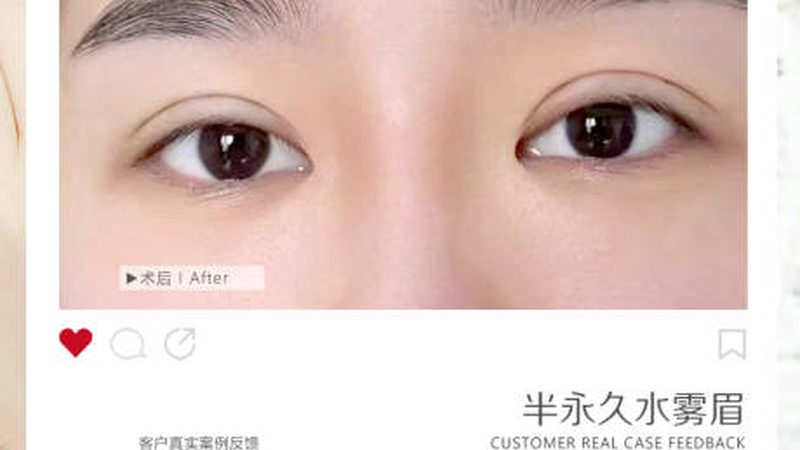 广州二氧化碳激光祛斑机：揭秘其工作原理与选购要点**